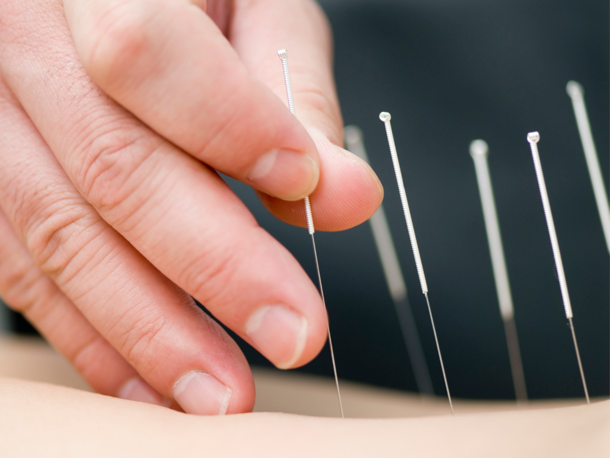 Acupunture Singapore